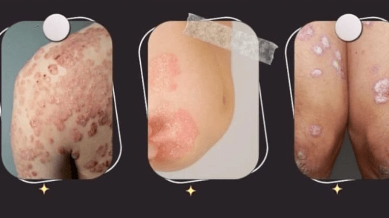 El 3% de la población vive con psoriasis y la mayoría no lo sabe