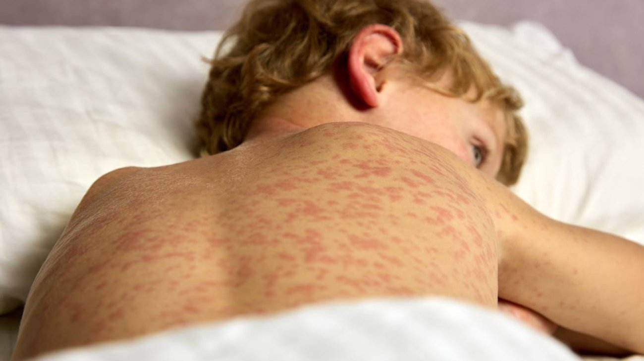 El_sarampion_regresa_causas_del_repunte_y_como_frenarlofeqfc_76056c9ce8