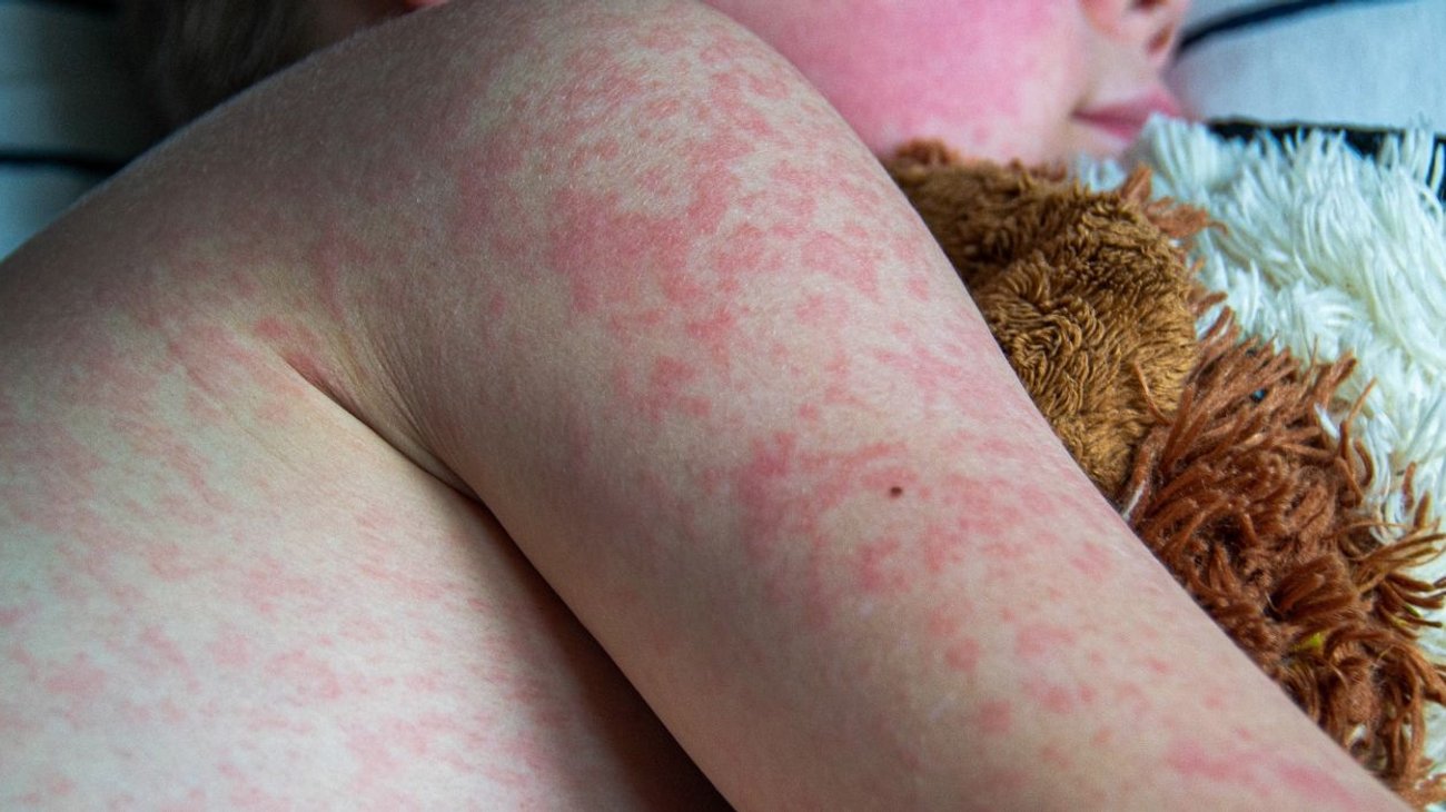 Emite Chiapas aviso epidemiológico por brote de sarampión