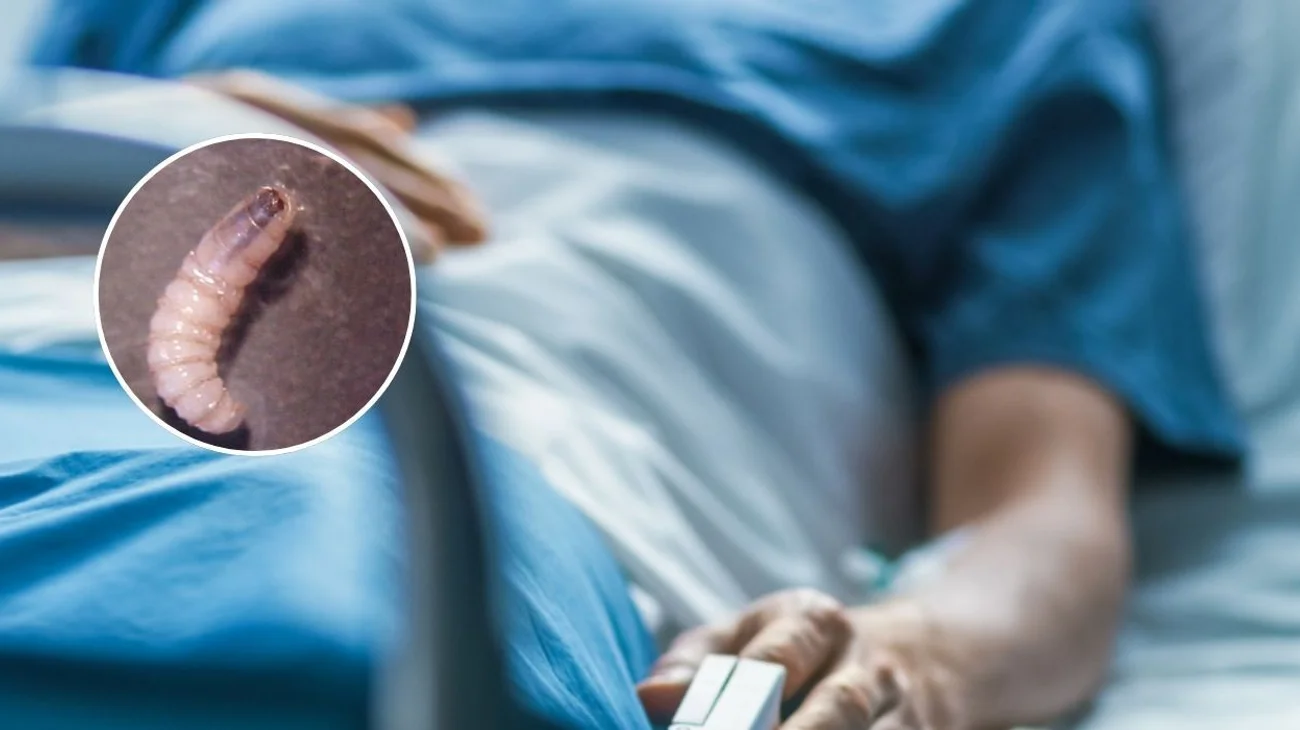 Segundo caso humano de miasis por gusano barrenador en Chiapas