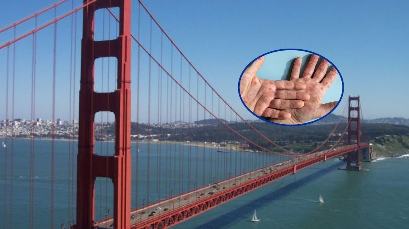 Aumentan casos de viruela del mono en California 