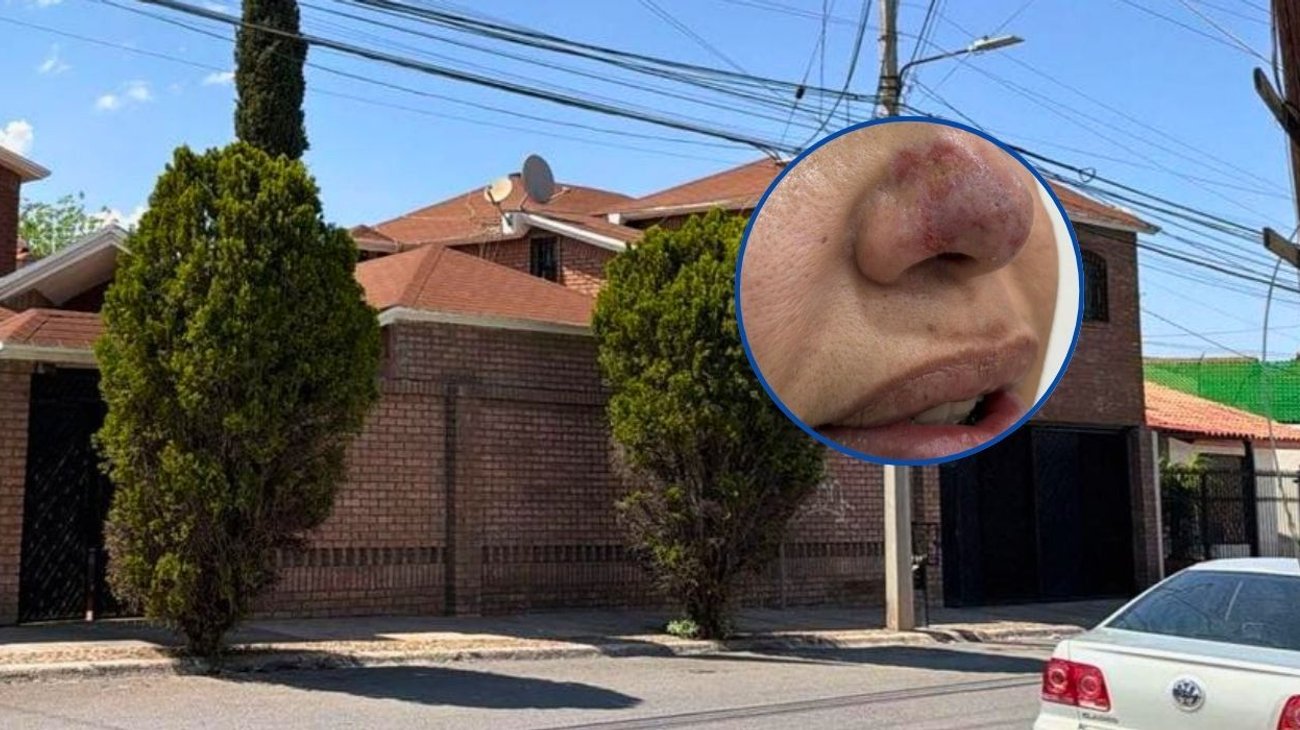 Pesadilla en Saltillo: rinomodelación termina en necrosis