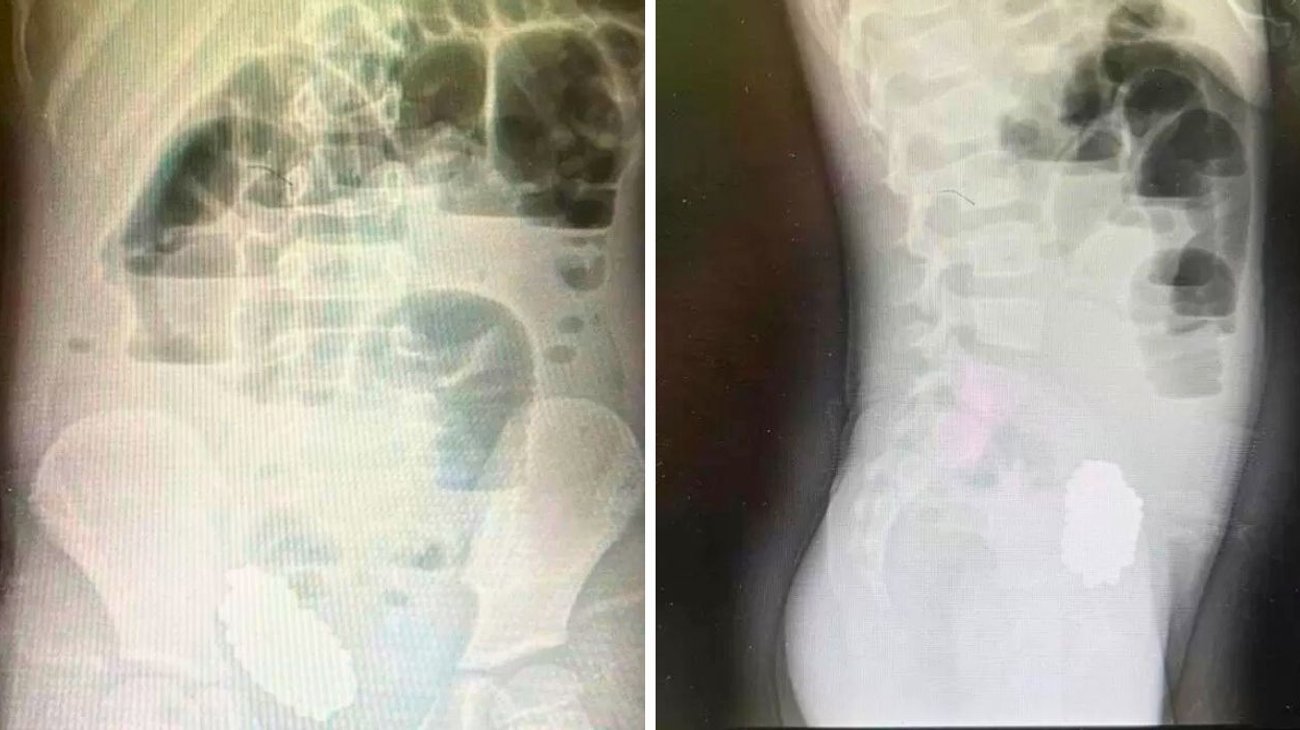 Médicos salvan a una niña que se tragó 134 bolas magnéticas