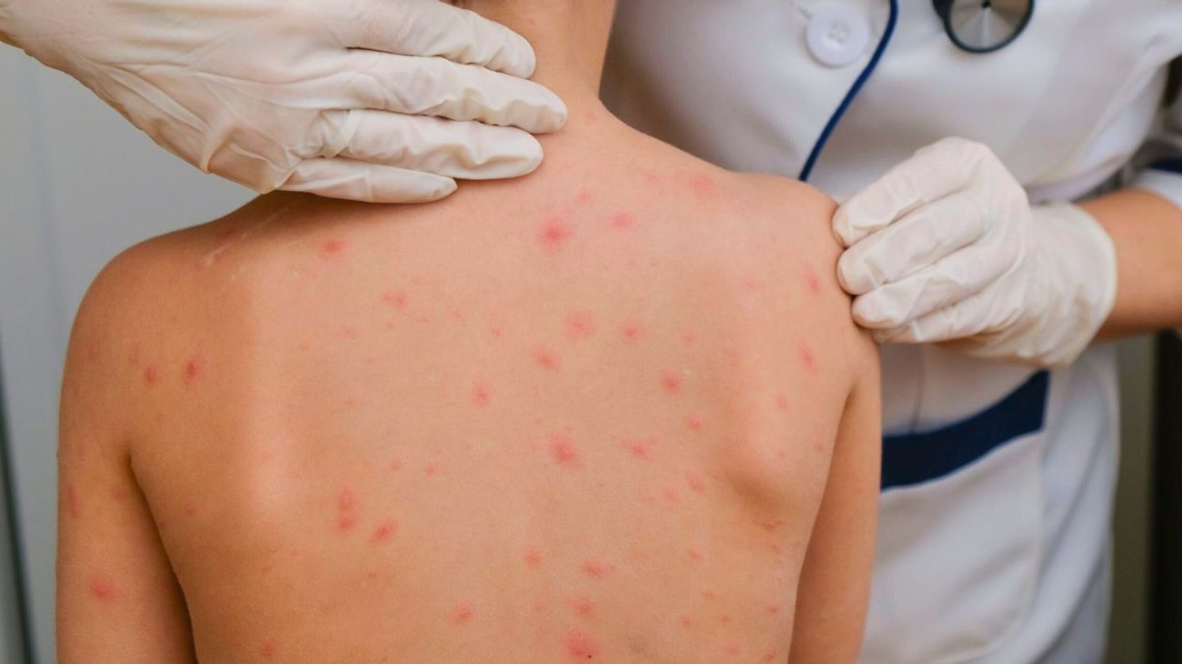 Texas anuncia el fin del brote de sarampión tras más de 700 casos