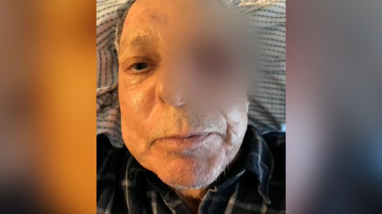 César Bono pierde ojo izquierdo tras diagnóstico de un tumor