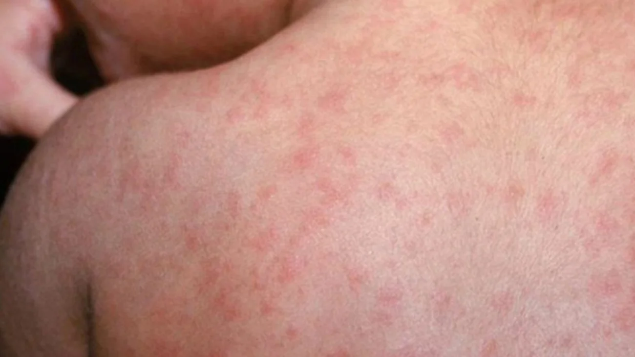 Reportan primer caso de sarampión en Guanajuato; un menor de edad