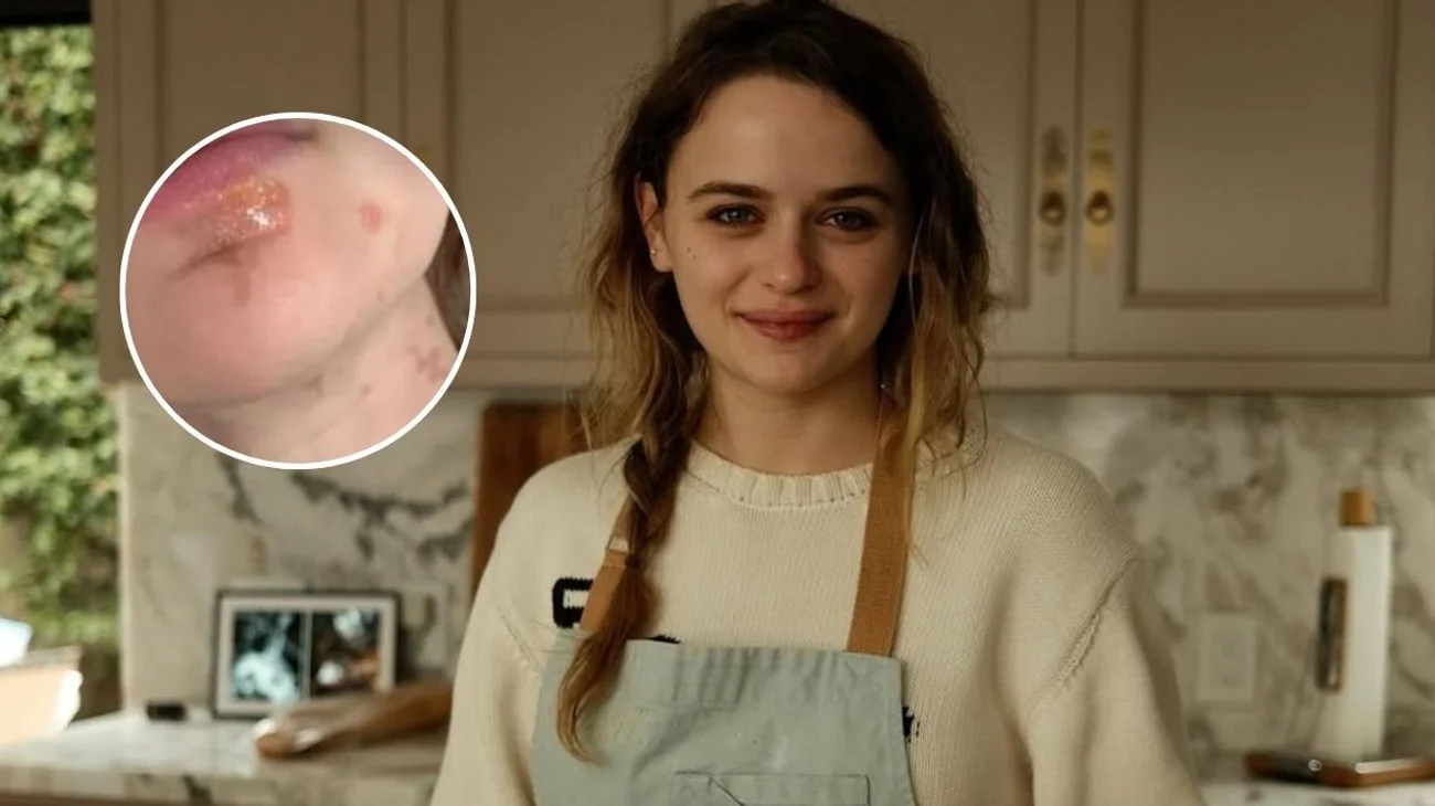 Joey King tiene terrible accidente y sufre quemaduras en rostro
