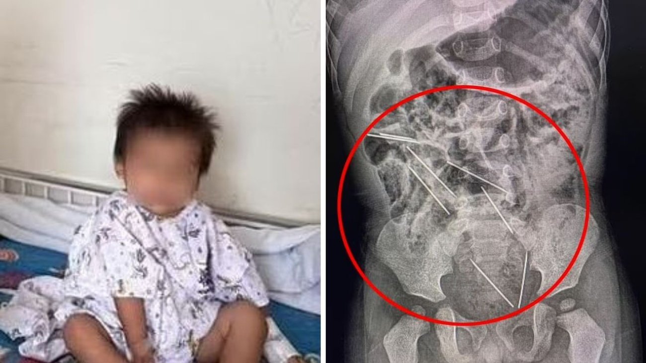 Bebé de 2 años se traga 8 agujas y logra sobrevivir
