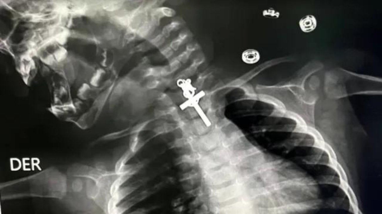 Bebé se traga crucifijo de metal y termina en quirófano