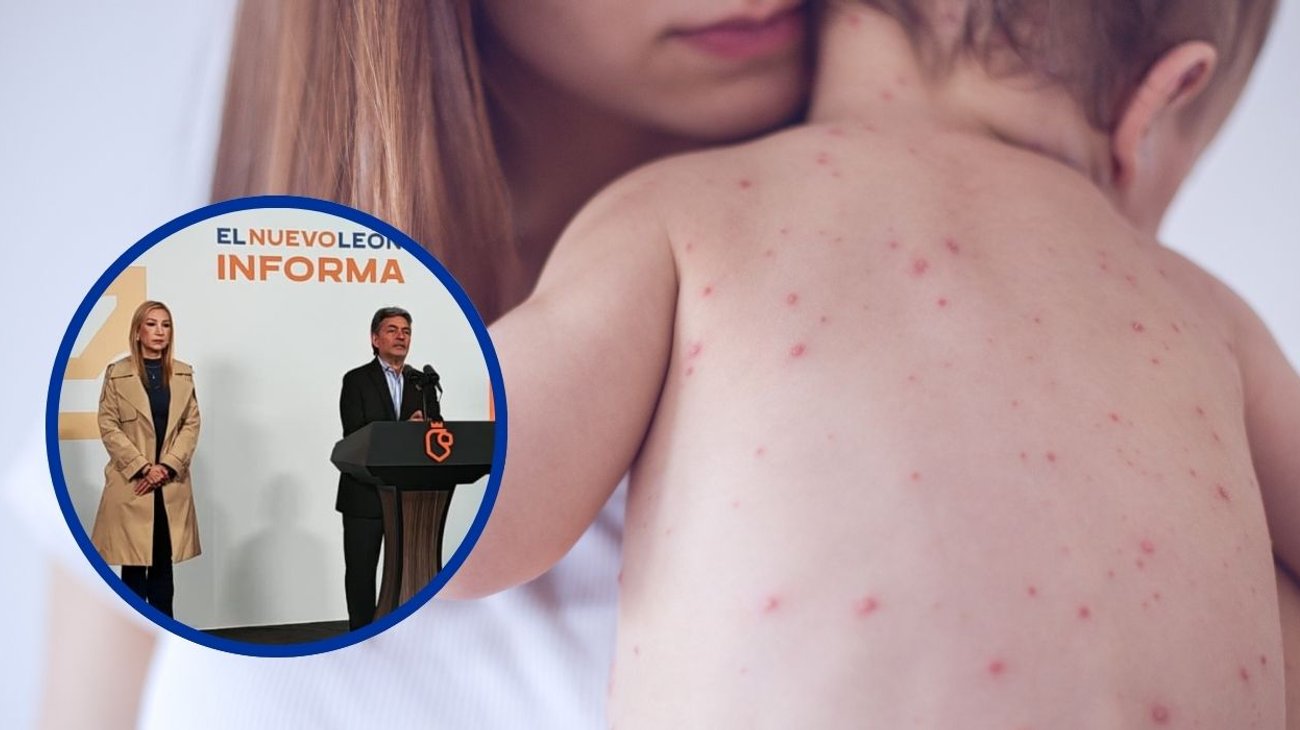 Activan alerta sanitaria por caso de sarampión en Nuevo León