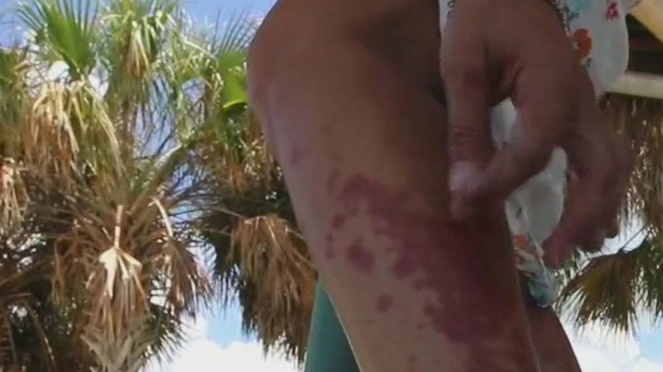 En Florida 5 muertes y 26 infectados por bacteria come-carne