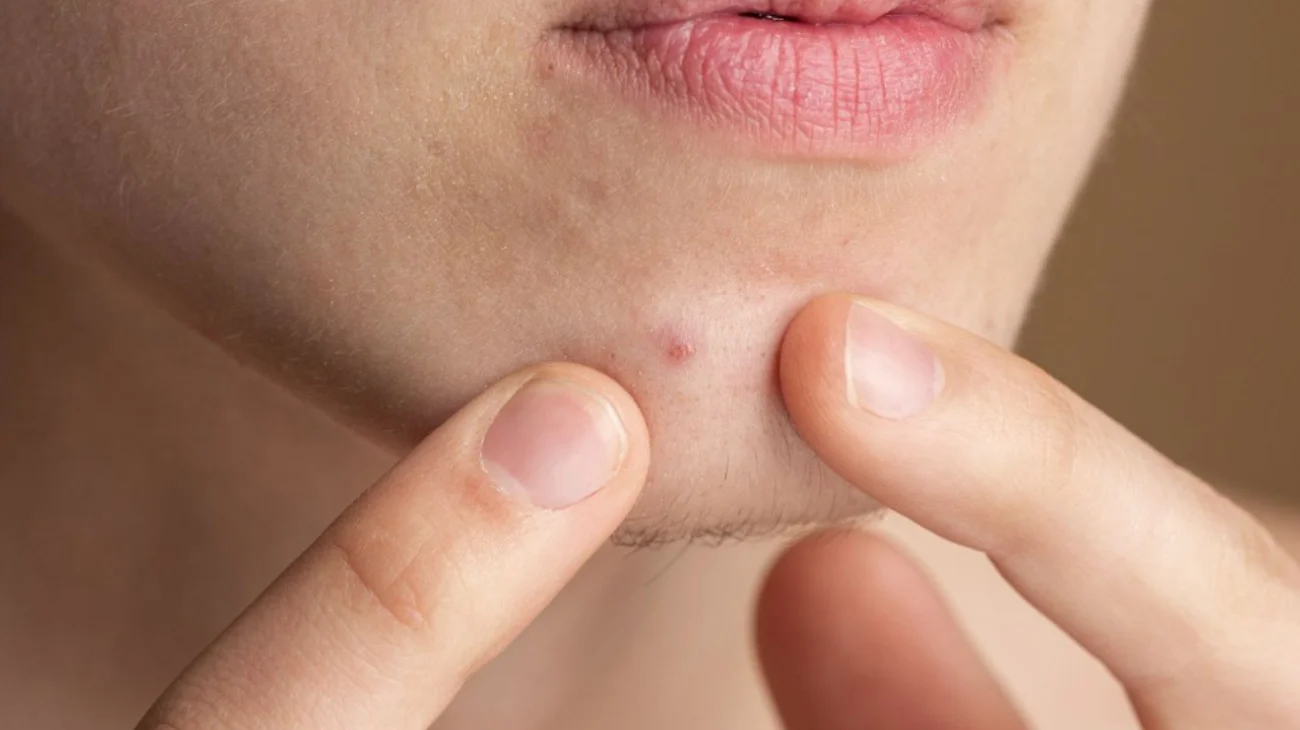 90% de adolescentes y 40% de adultos en México padecen acné