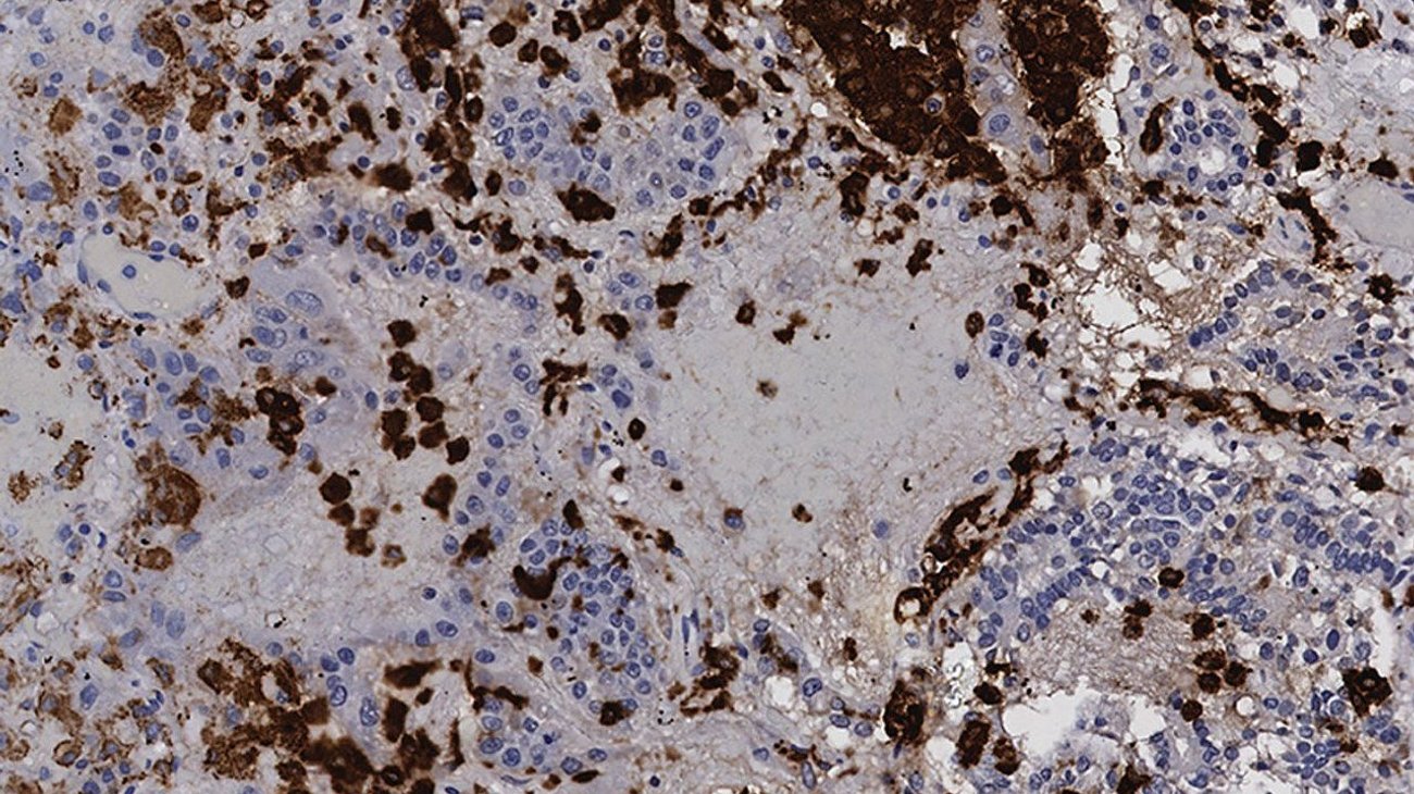 Investigan medicamento contra el cáncer para tratar covid-19