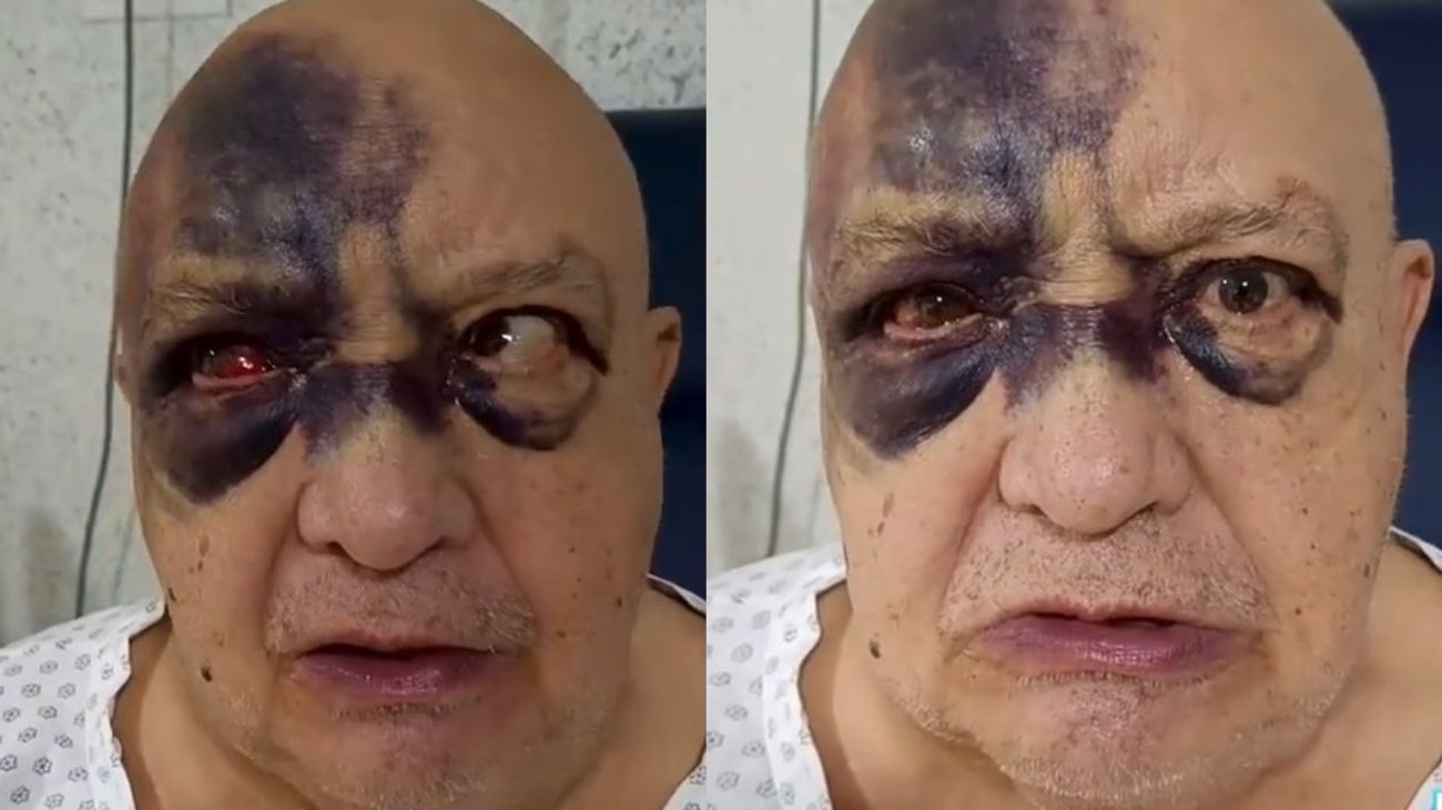 Preocupa Luis de Alba por aparecer con lleno de hematomas