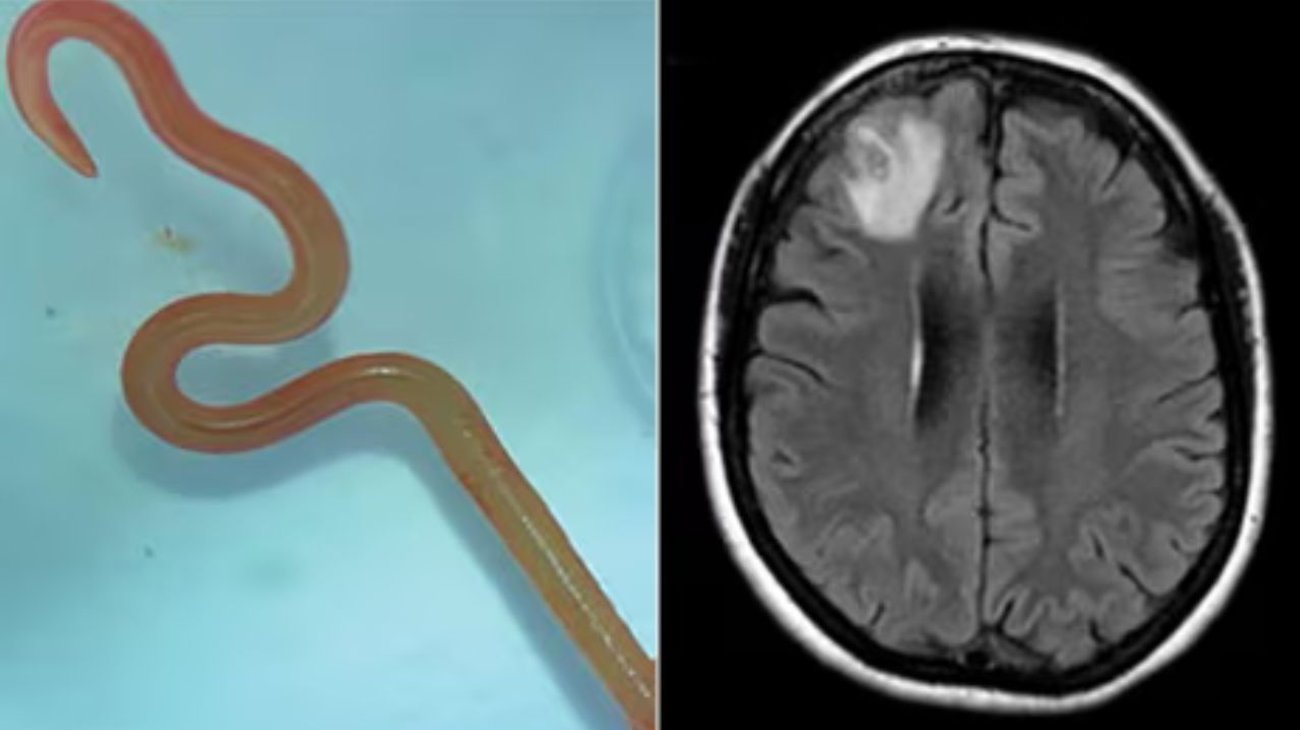 Extraen de cerebro lombriz intestinal viva de 8 centímetros