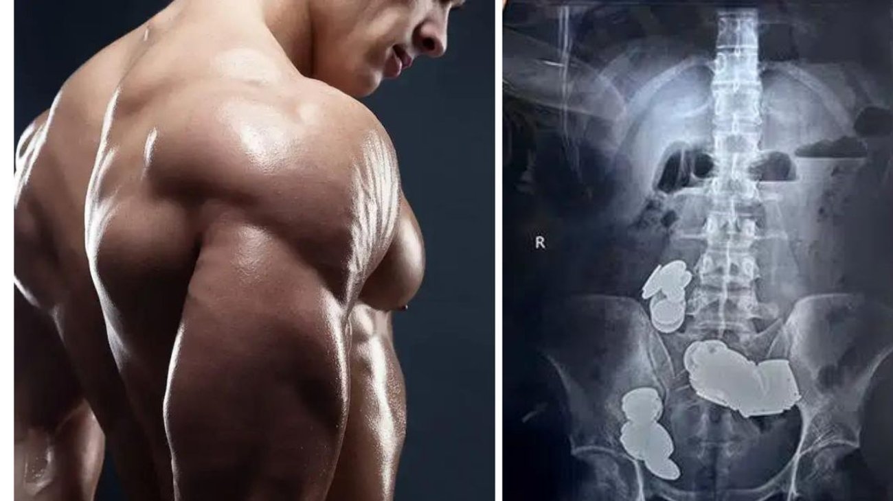 ¡Insólito! Hombre se traga 39 monedas para obtener zinc