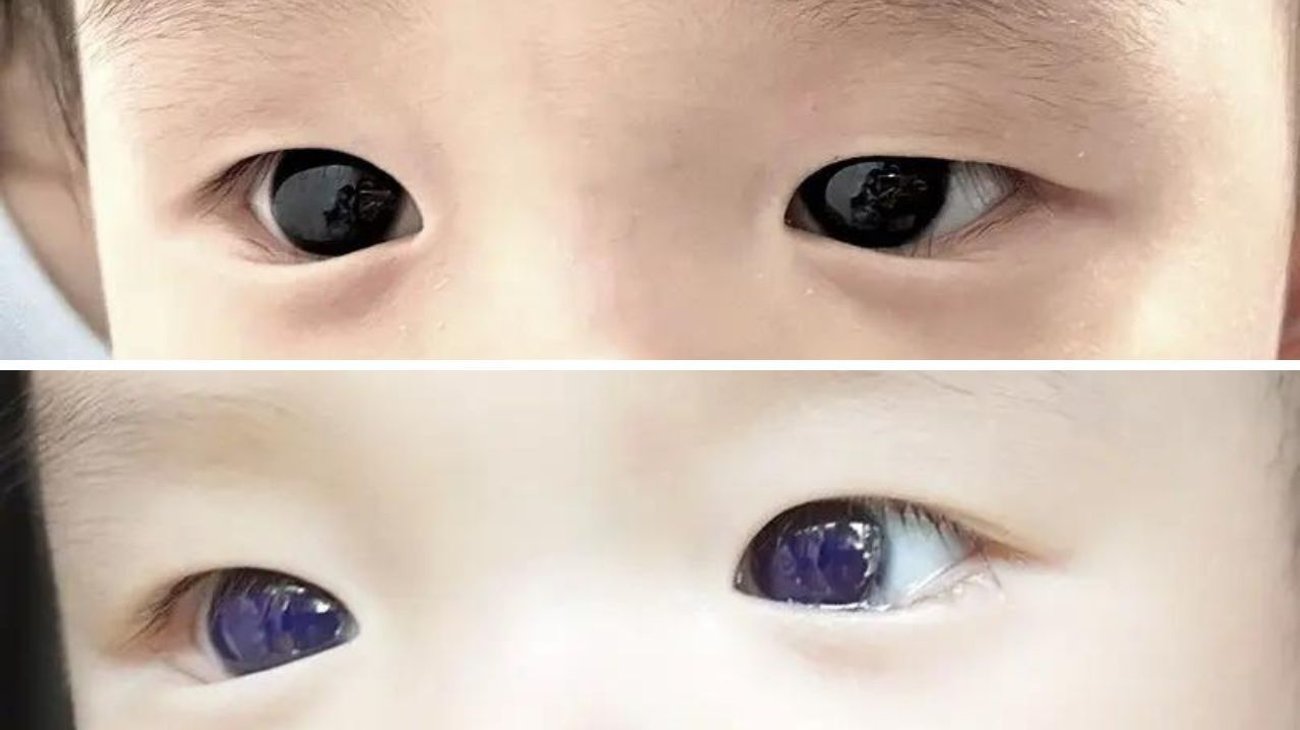 Ojos de bebé cambian de color tras tratamiento contra Covid