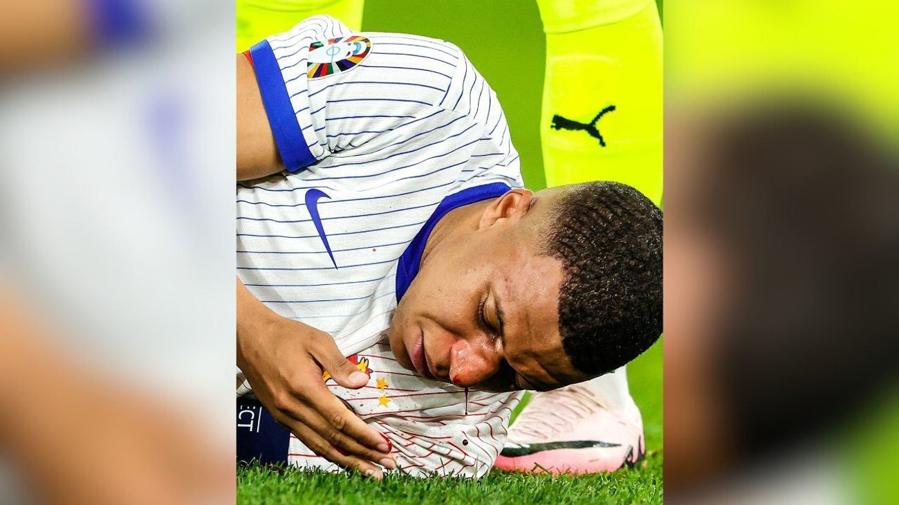 Mbappé sufre fractura nasal y podría perderse la Eurocopa