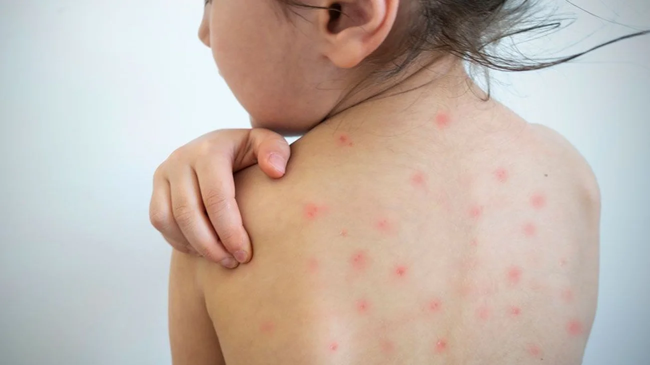 measles_su19_f3c8ff354c