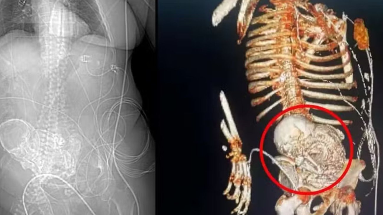Mujer cargó con un feto calcificado por ¡56 años!