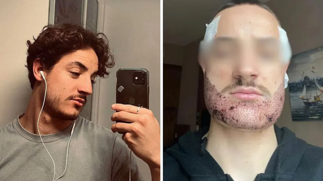 Se hace trasplante de barba con falso cirujano y muere