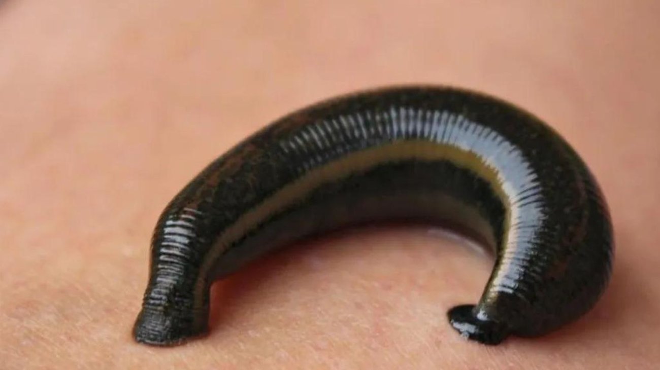 Descubre por dolor que tenía sanguijuela viva en la garganta