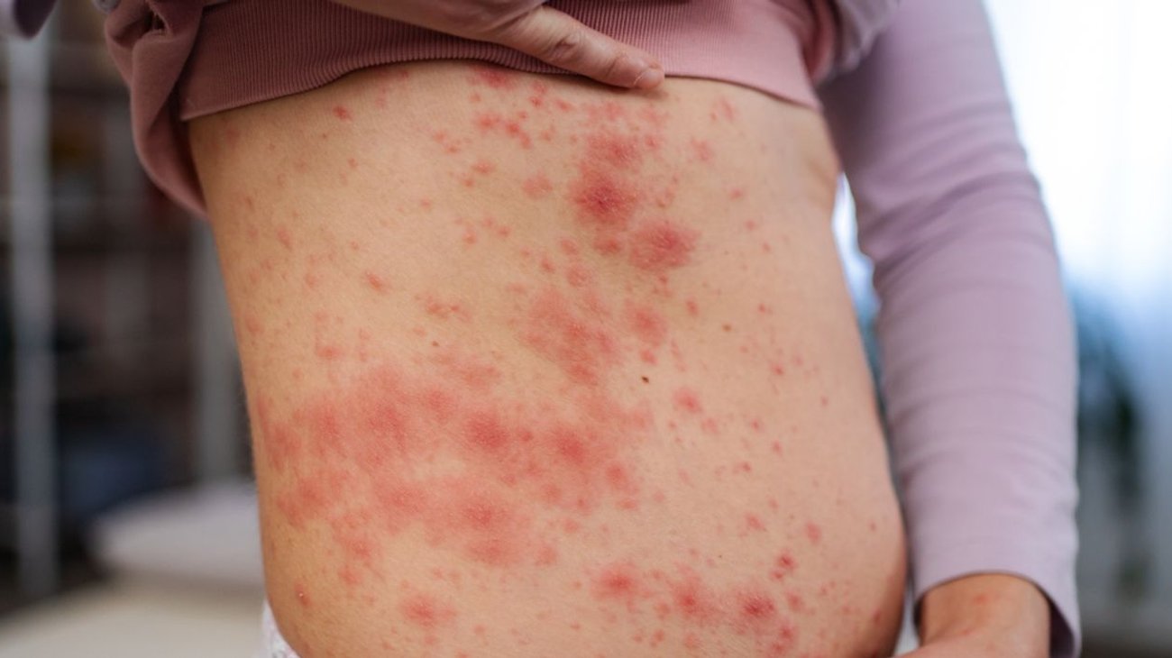 Sinaloa registra su primera defunción por sarampión