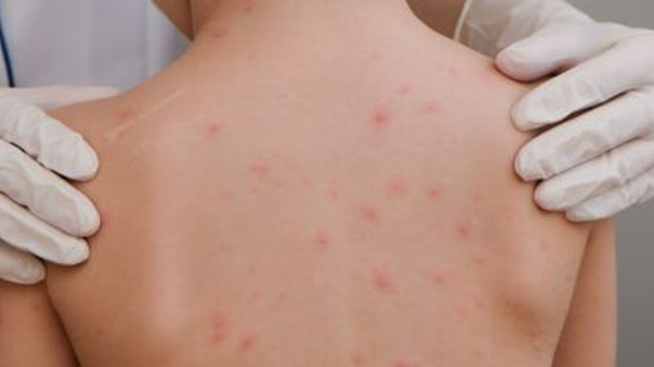 Descartan brote de sarampión en escuela de Reynosa