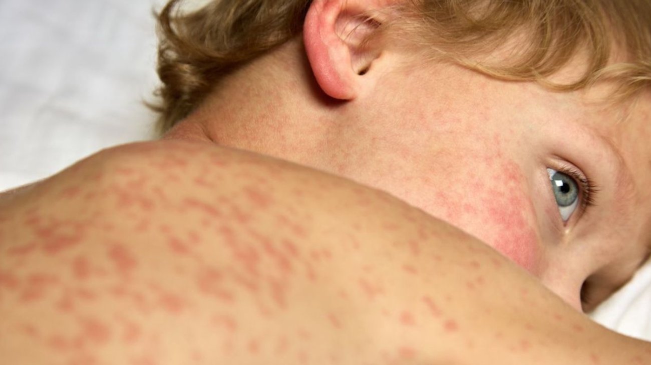 Contabilizan 31 decesos a causa de sarampión a nivel nacional