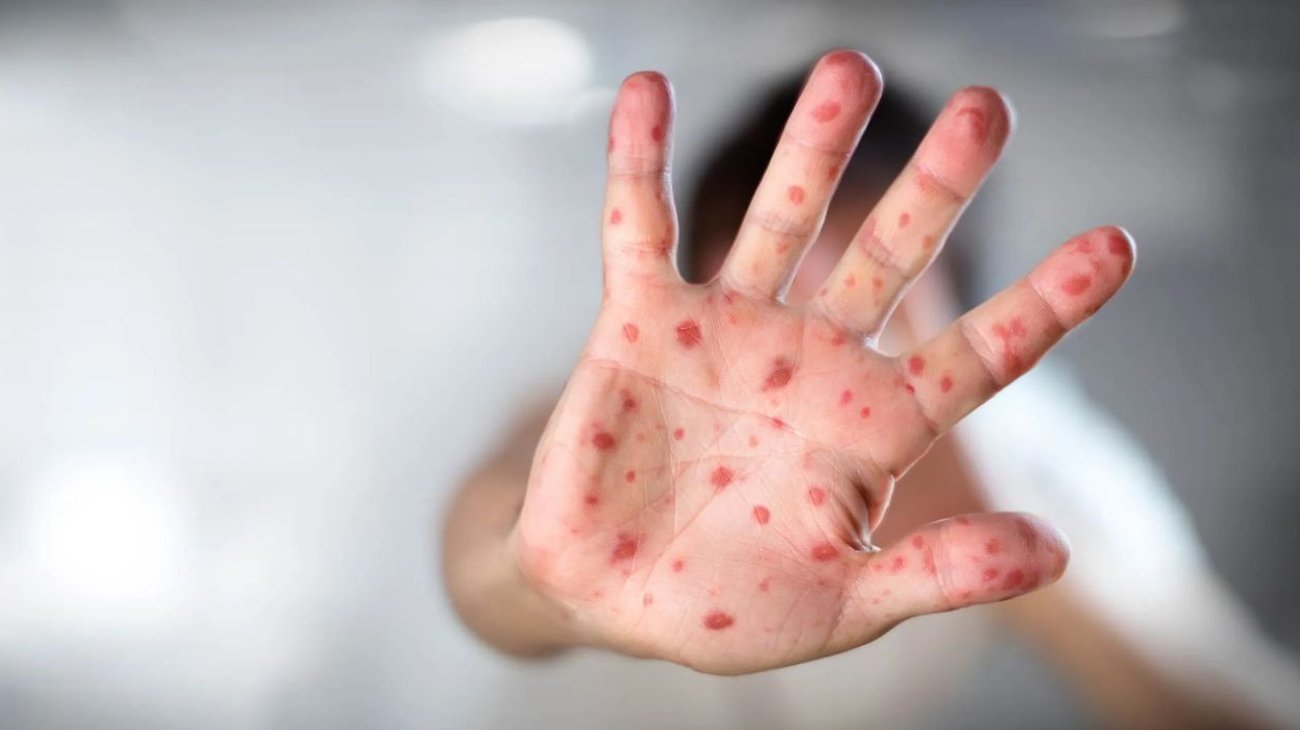 sarampion_mexico_casos_28_muertes_e7400738e2