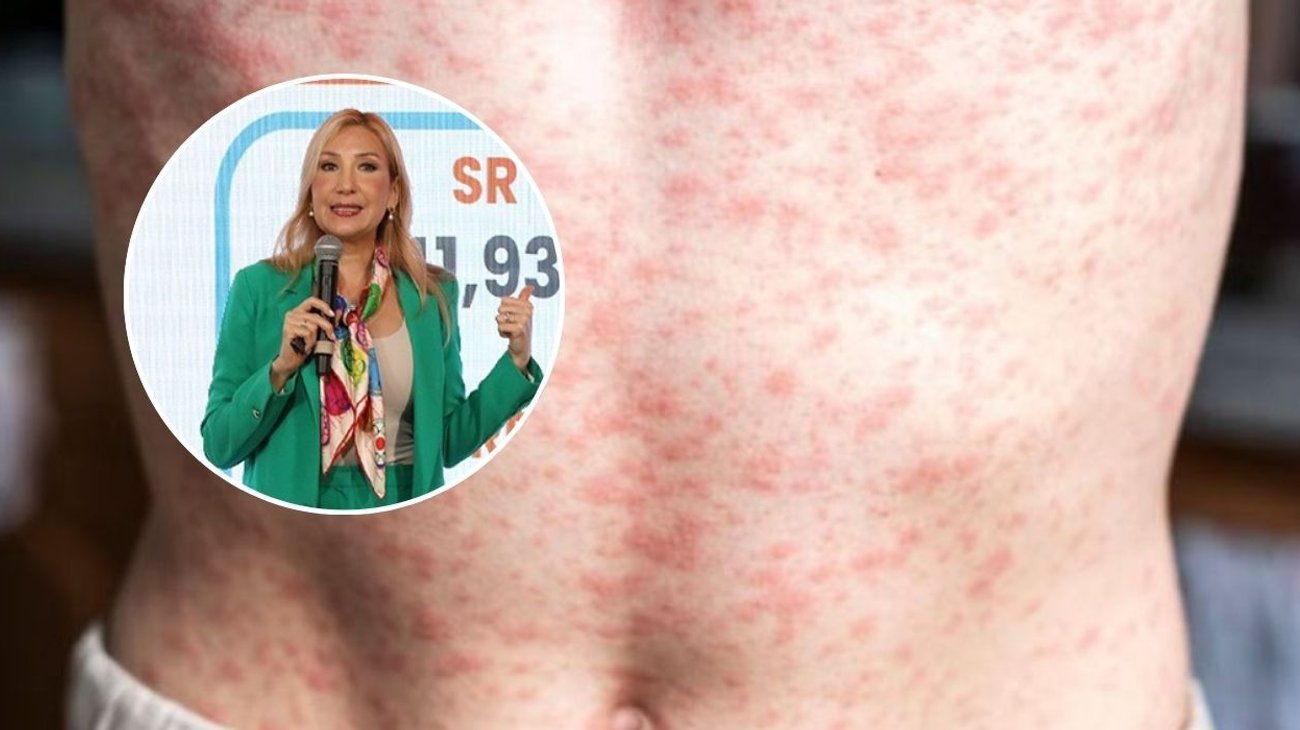 Pide Secretaría de Salud mantener guardia contra sarampión en NL