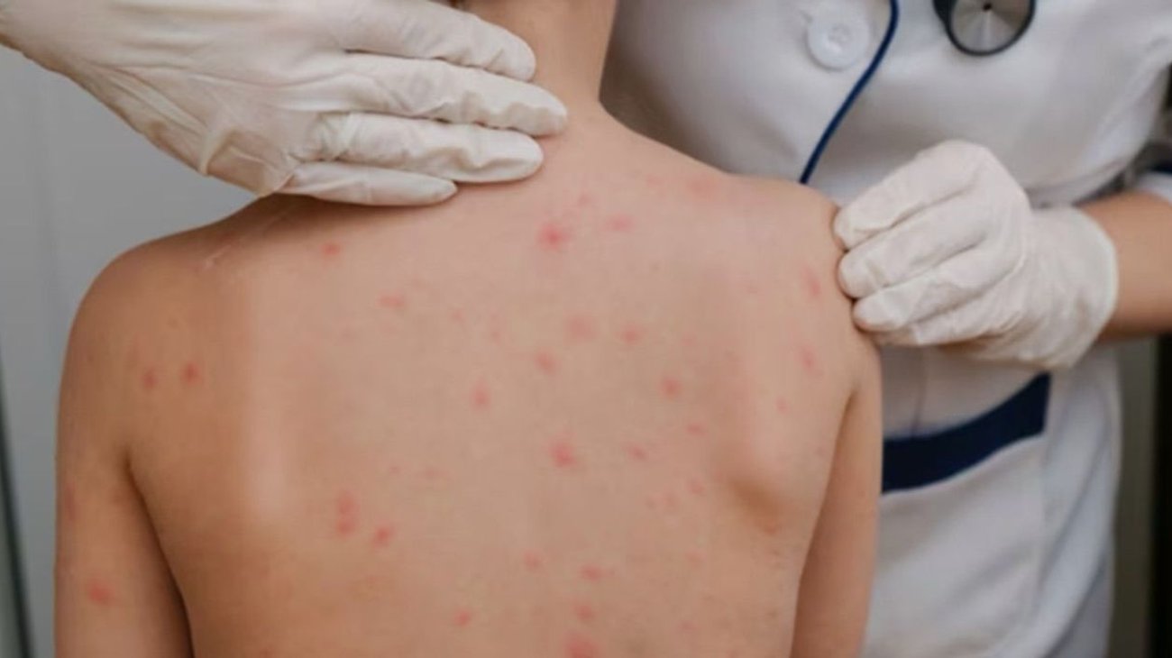 sarampion_nuevo_leon_81cd2a3a1b