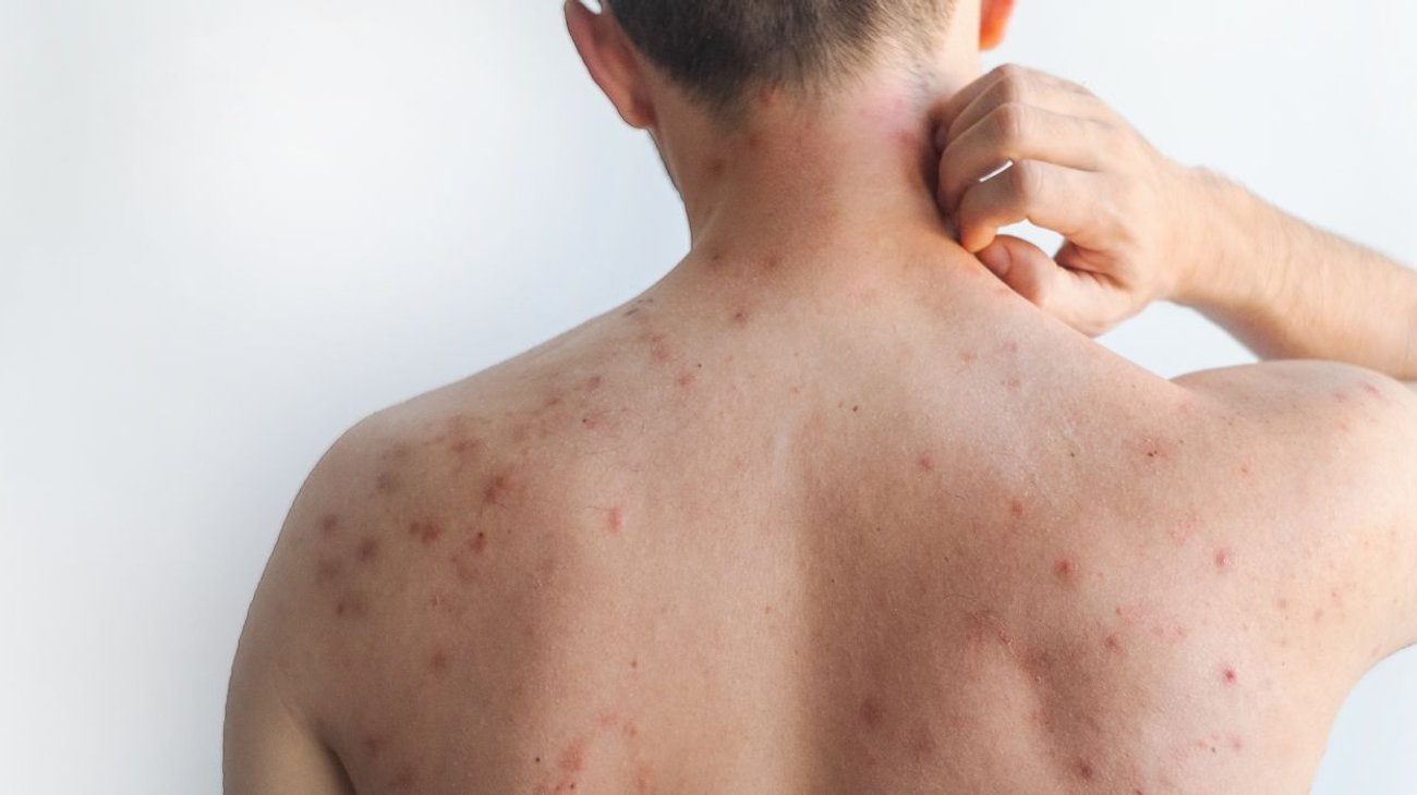 Confirman tercer caso de sarampión en Nuevo León en 2026