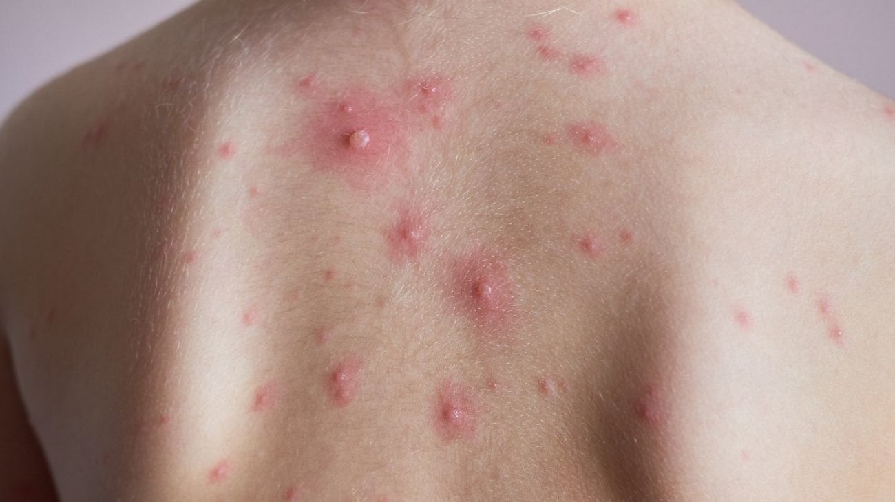 sarampion_varicela_reynosa_0c32a2342b