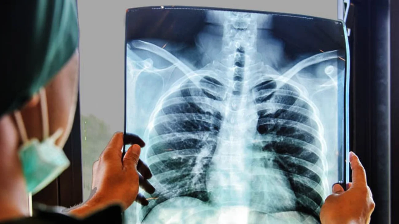 Brote de tuberculosis en Kansas City deja dos muertos