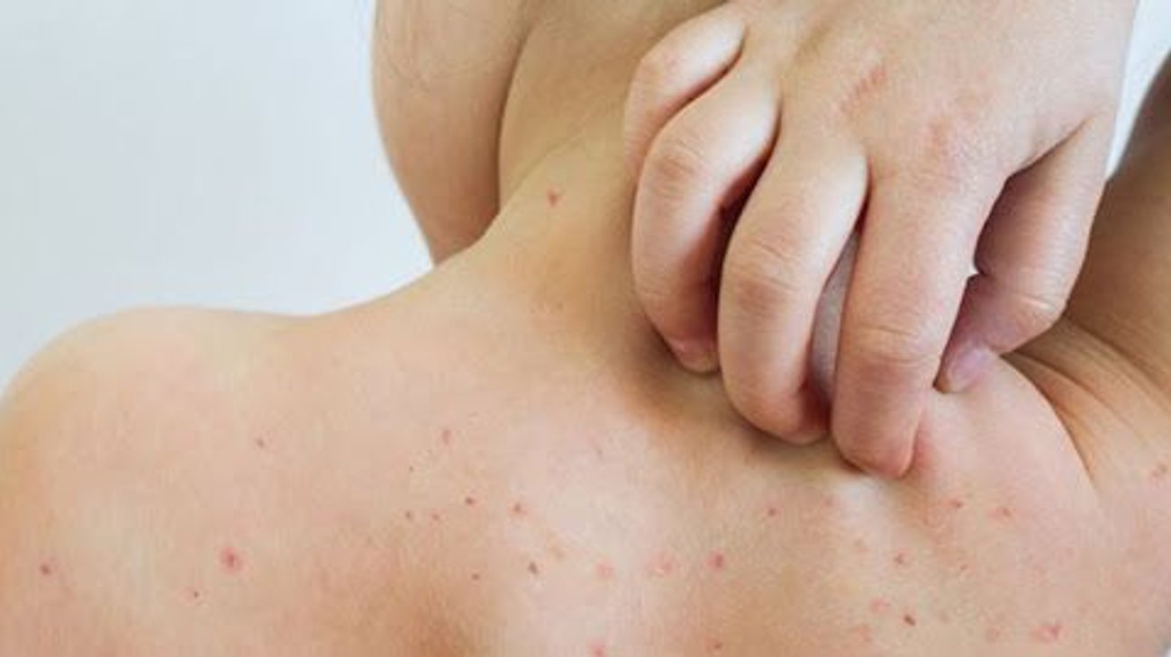  Vacuna contra el sarampión: fechas y módulos en NL