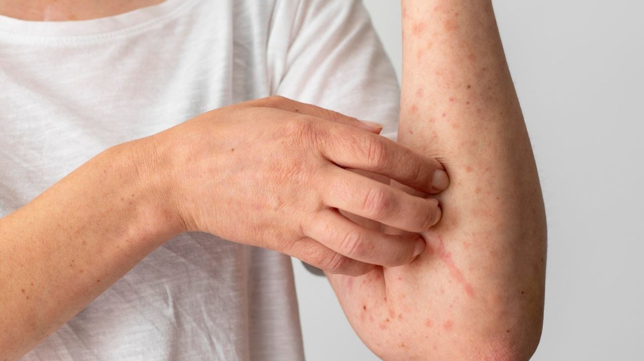 Confirma Tamaulipas un caso positivo de viruela del mono