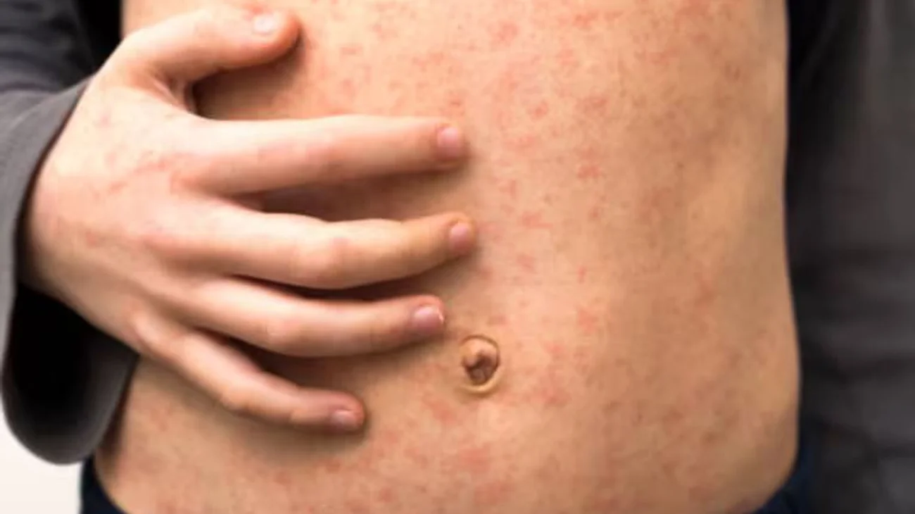 Suma México 362 casos de sarampión; está contenido en el país