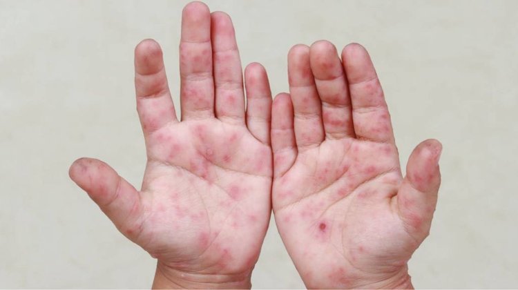 Mantiene Nuevo León vigilancia activa ante el virus coxsackie