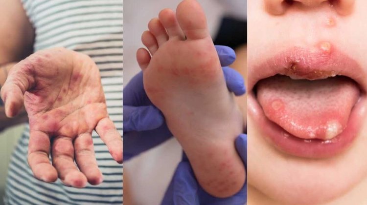 Brote de manos, pies y boca afecta escuelas en Condado de Hidalgo