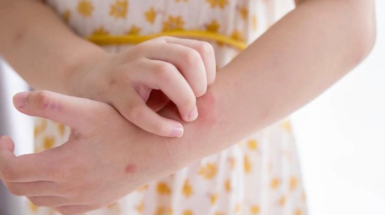 Virus Coxsackie en niños de Apodaca es estacional: Salud