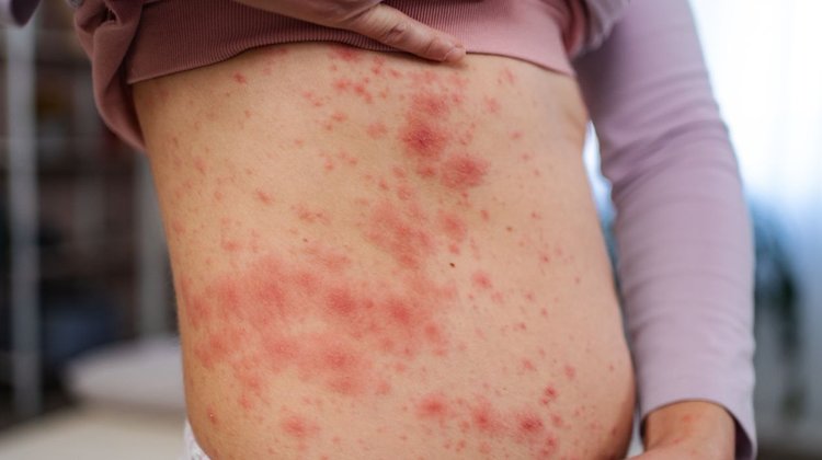 Sinaloa registra su primera defunción por sarampión