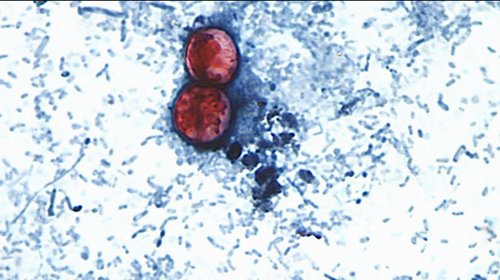 Investigan en EUA nuevo brote de cyclospora con 72 casos