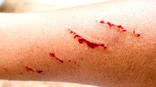 Muere_adolescente_en_Zacatecas_bajo_sospecha_de_rabia_humana_21a76a9472