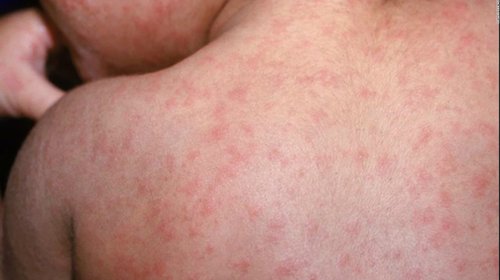 cnne_640821_aumentan_casos_de_sarampion_ee_uu_48a317c2af