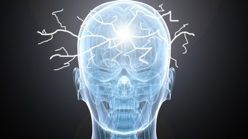 epilepsia_5dd0852221