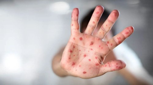 sarampion_11_mil_casos_53b4767870