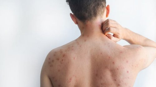 sarampion_mexico_2c45fc3340