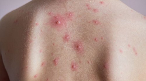 sarampion_varicela_reynosa_0c32a2342b