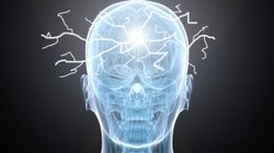 epilepsia_5dd0852221